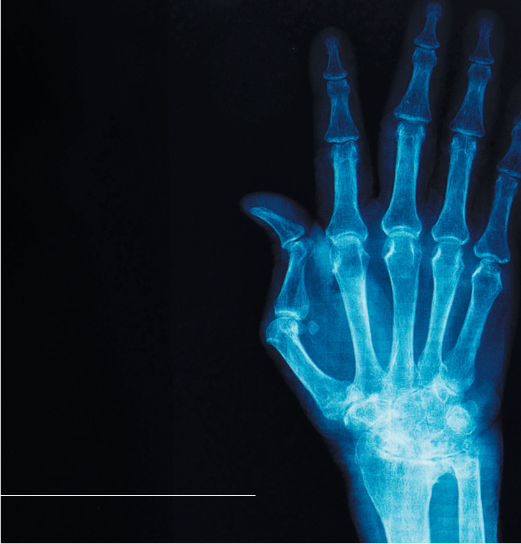Pioneering precision medicine in rheumatoid arthritis
